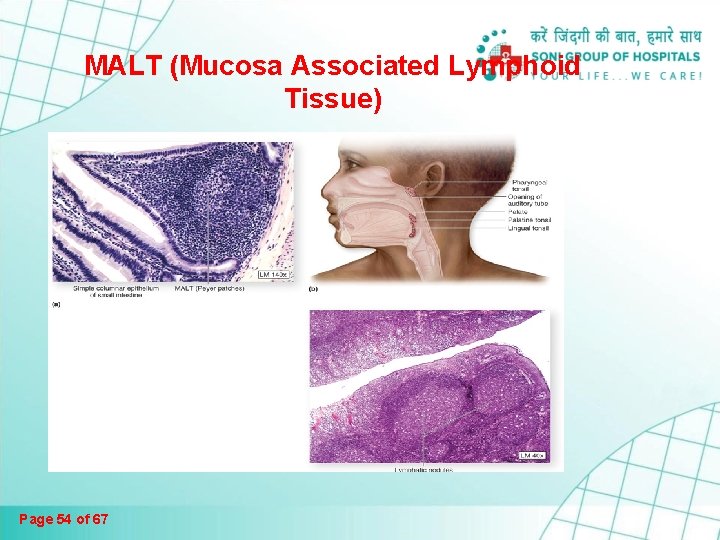 MALT (Mucosa Associated Lymphoid Tissue) Page 54 of 67 MALT (Mucosa Associated Lymphoid Tissue) Page 54 of 67