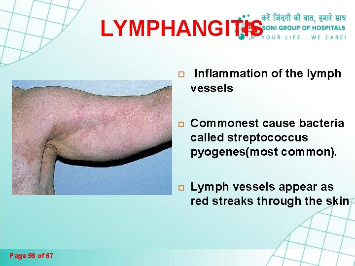 LYMPHANGITIS Inflammation of the lymph vessels Page 56 of 67 Commonest cause bacteria called LYMPHANGITIS Inflammation of the lymph vessels Page 56 of 67 Commonest cause bacteria called