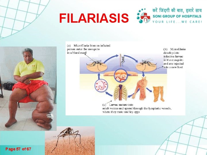 FILARIASIS Page 57 of 67 FILARIASIS Page 57 of 67