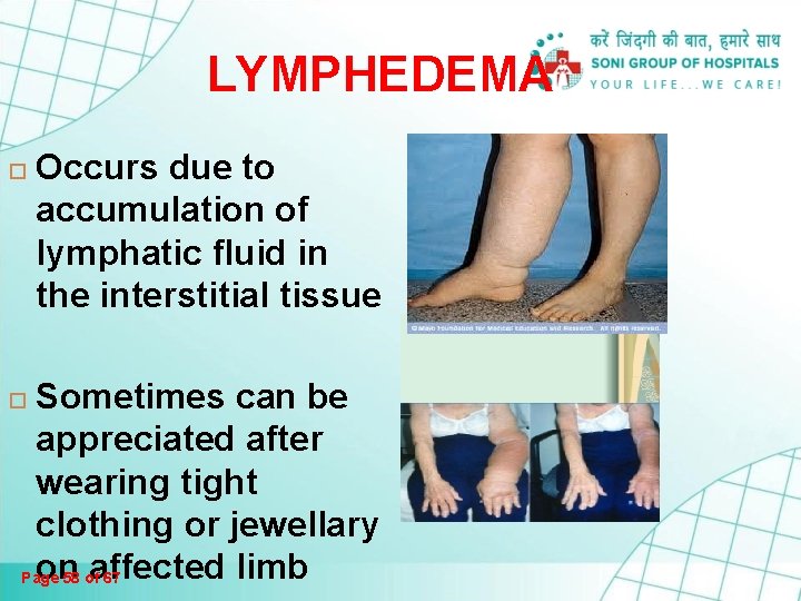 LYMPHEDEMA Occurs due to accumulation of lymphatic fluid in the interstitial tissue Sometimes can LYMPHEDEMA Occurs due to accumulation of lymphatic fluid in the interstitial tissue Sometimes can