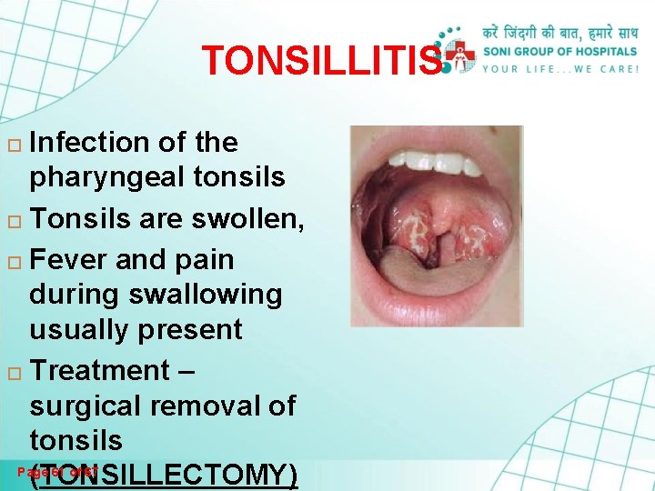 TONSILLITIS Infection of the pharyngeal tonsils Tonsils are swollen, Fever and pain during swallowing TONSILLITIS Infection of the pharyngeal tonsils Tonsils are swollen, Fever and pain during swallowing