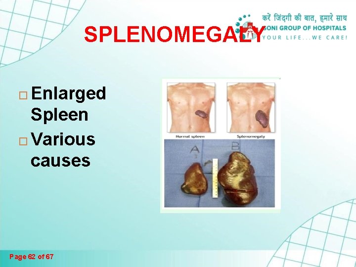SPLENOMEGALY Enlarged Spleen Various causes Page 62 of 67 SPLENOMEGALY Enlarged Spleen Various causes Page 62 of 67