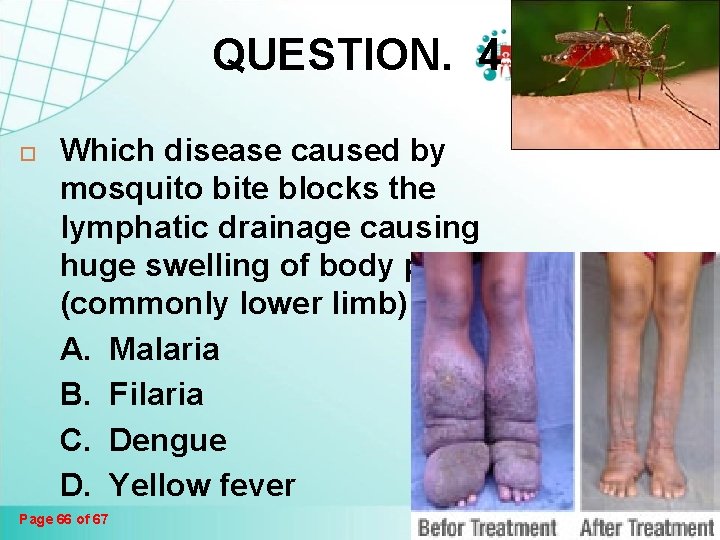 QUESTION. 4 Which disease caused by mosquito bite blocks the lymphatic drainage causing huge QUESTION. 4 Which disease caused by mosquito bite blocks the lymphatic drainage causing huge