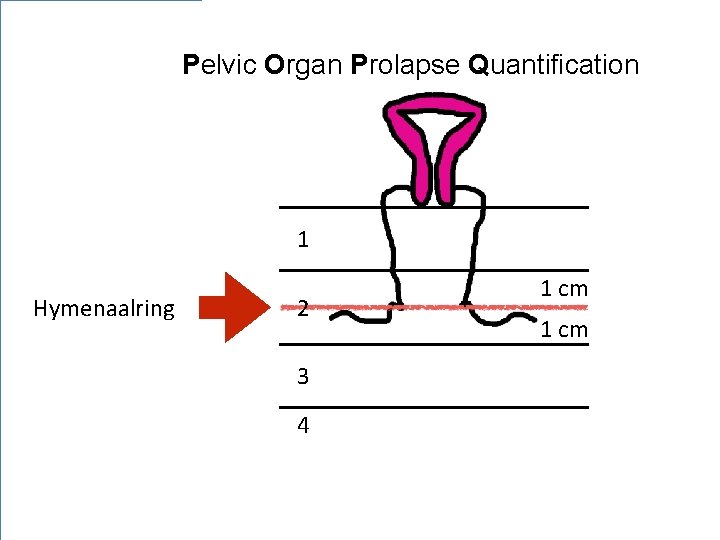Pelvic Organ Prolapse Quantification 1 Hymenaalring 2 3 4 1 cm 