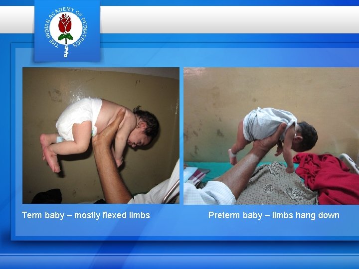 Term baby – mostly flexed limbs Preterm baby – limbs hang down 