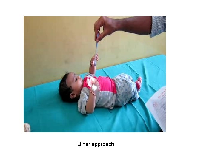 Ulnar approach 