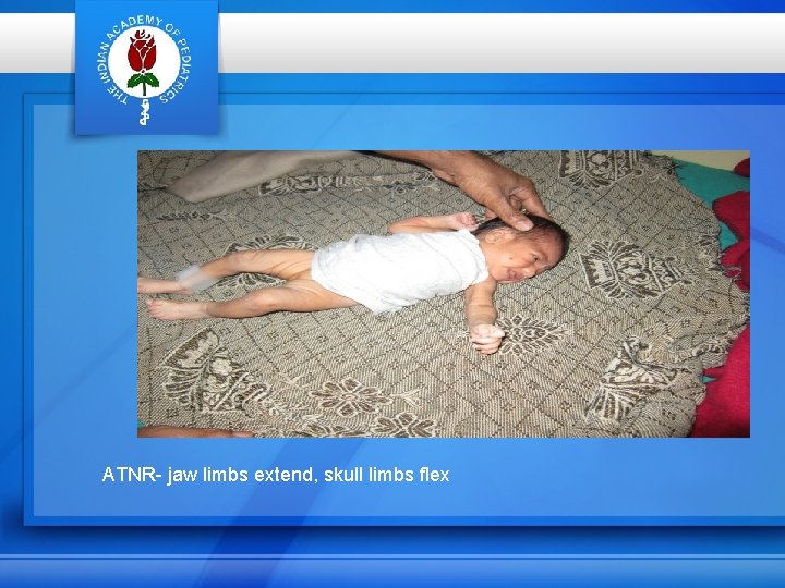 ATNR- jaw limbs extend, skull limbs flex 