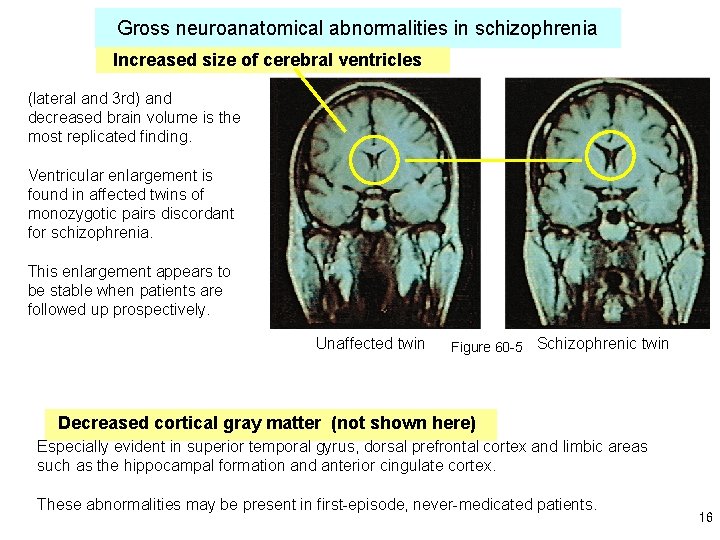 Gross neuroanatomical abnormalities in schizophrenia Increased size of cerebral ventricles (lateral and 3 rd)