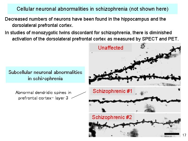 Cellular neuronal abnormalities in schizophrenia (not shown here) Decreased numbers of neurons have been