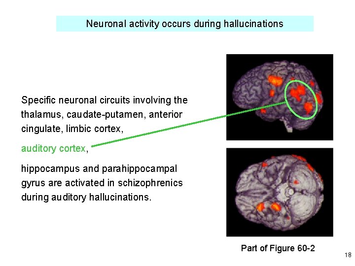 Neuronal activity occurs during hallucinations Specific neuronal circuits involving the thalamus, caudate-putamen, anterior cingulate,