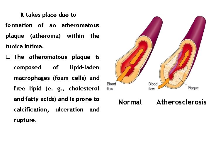 It takes place due to formation of an atheromatous plaque (atheroma) within the tunica