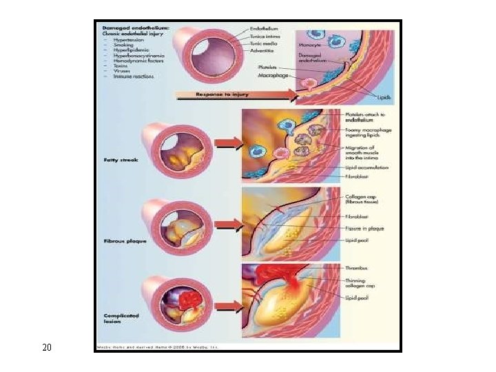 Atherosclerosis 20 