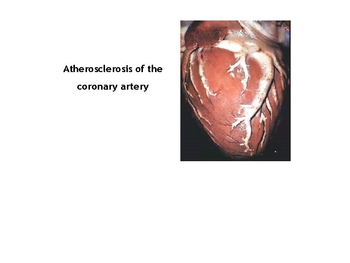 Atherosclerosis of the coronary artery 