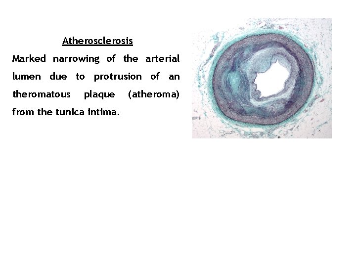 Atherosclerosis Marked narrowing of the arterial lumen due to protrusion of an theromatous plaque
