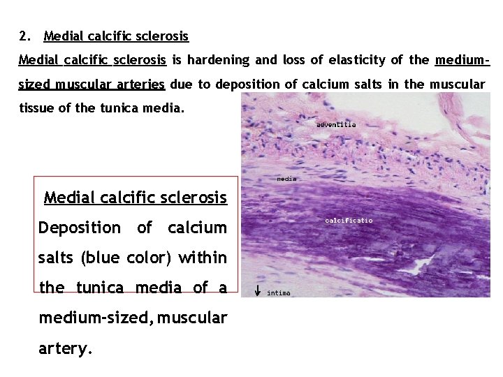 2. Medial calcific sclerosis is hardening and loss of elasticity of the mediumsized muscular