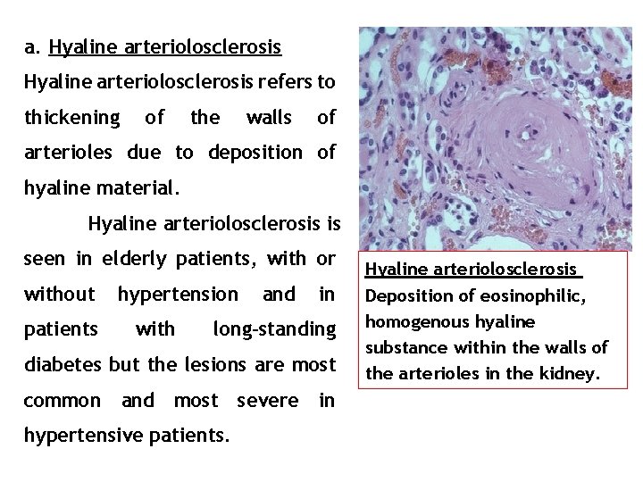 a. Hyaline arteriolosclerosis refers to thickening of the walls of arterioles due to deposition