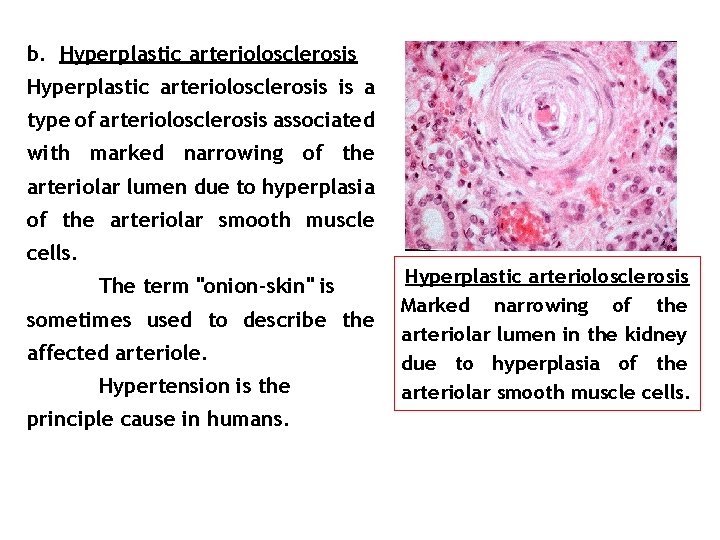 b. Hyperplastic arteriolosclerosis is a type of arteriolosclerosis associated with marked narrowing of the