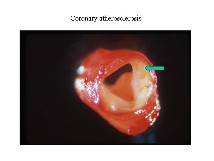 Coronary atherosclerosis 