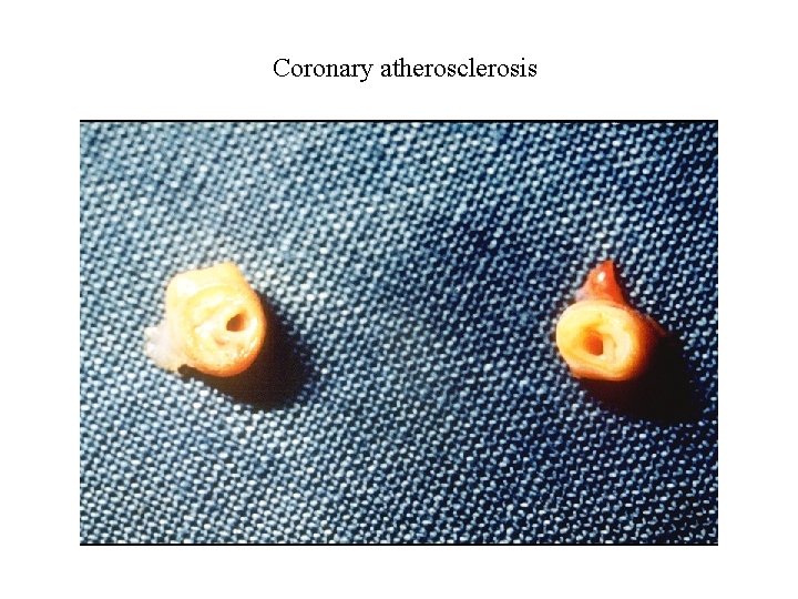 Coronary atherosclerosis 