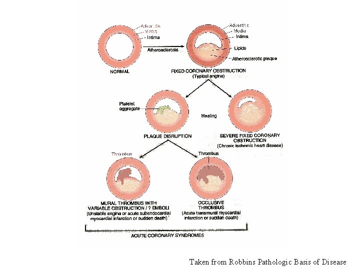 Taken from Robbins Pathologic Basis of Disease 