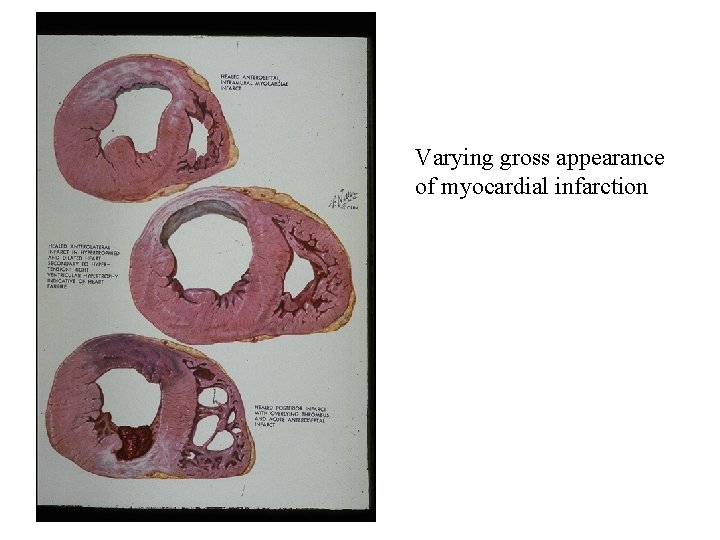 Varying gross appearance of myocardial infarction 