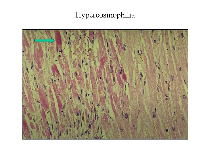 Hypereosinophilia 