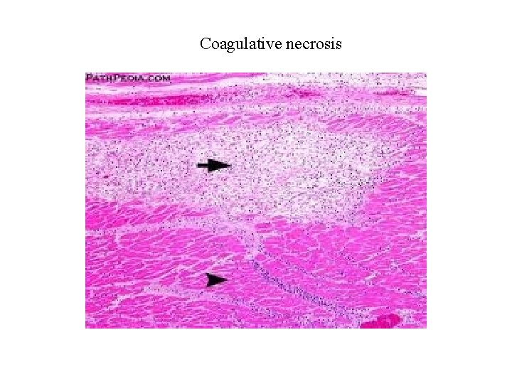 Coagulative necrosis 