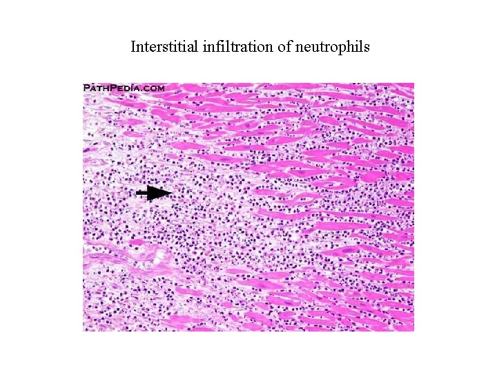 Interstitial infiltration of neutrophils 