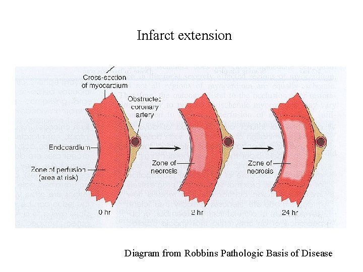 Infarct extension Diagram from Robbins Pathologic Basis of Disease 