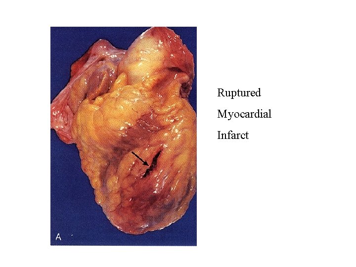 Ruptured Myocardial Infarct 