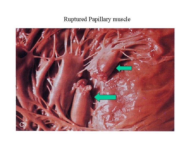 Ruptured Papillary muscle 