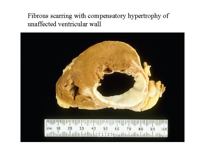Fibrous scarring with compensatory hypertrophy of unaffected ventricular wall 