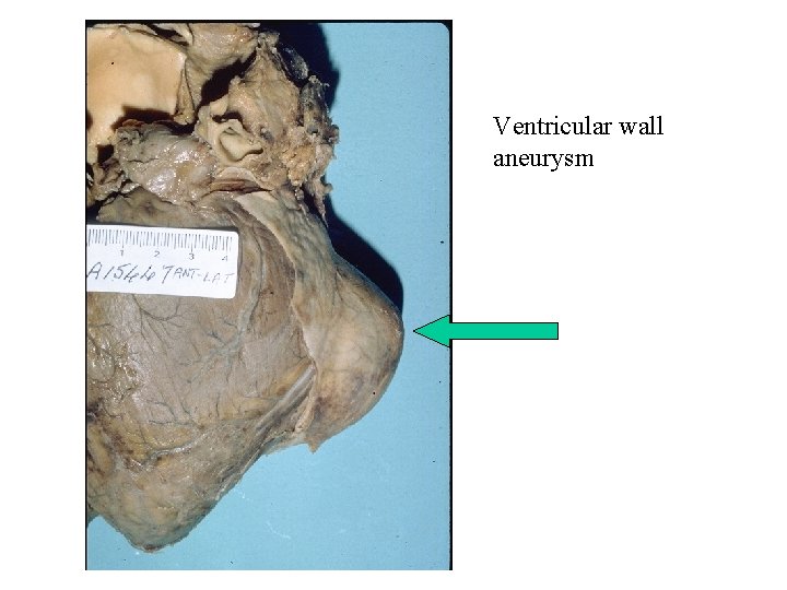 Ventricular wall aneurysm 