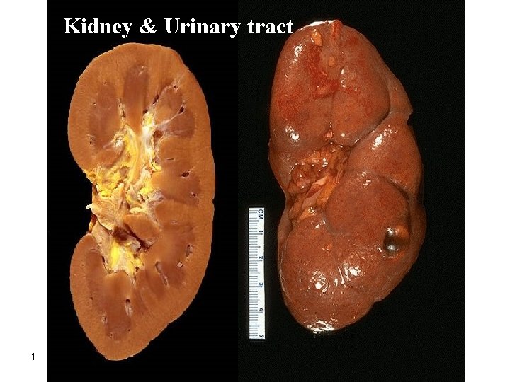 Kidney & Urinary tract 1 