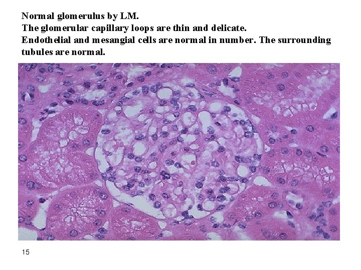 Normal glomerulus by LM. The glomerular capillary loops are thin and delicate. Endothelial and
