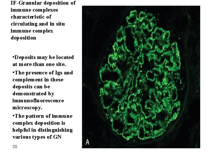 IF-Granular deposition of immune complexes characteristic of circulating and in situ immune complex deposition