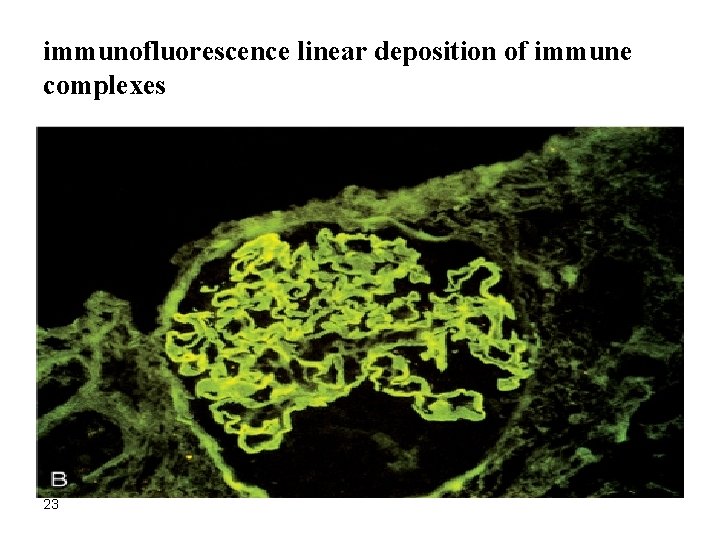 immunofluorescence linear deposition of immune complexes 23 