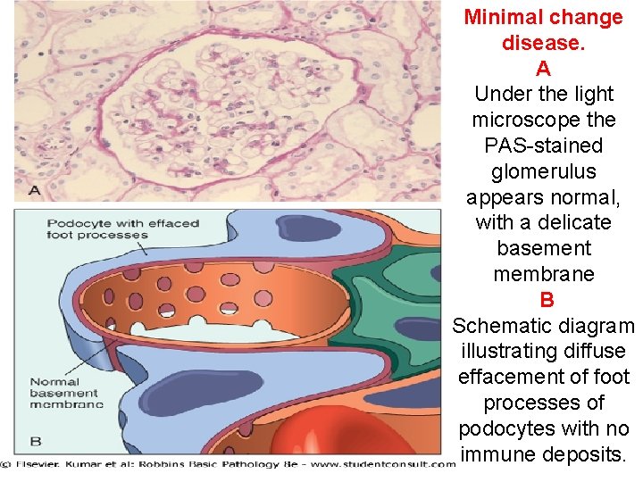 30 Minimal change disease. A Under the light microscope the PAS-stained glomerulus appears normal,