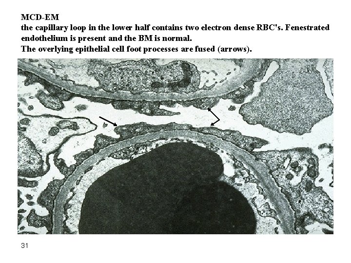 MCD-EM the capillary loop in the lower half contains two electron dense RBC's. Fenestrated