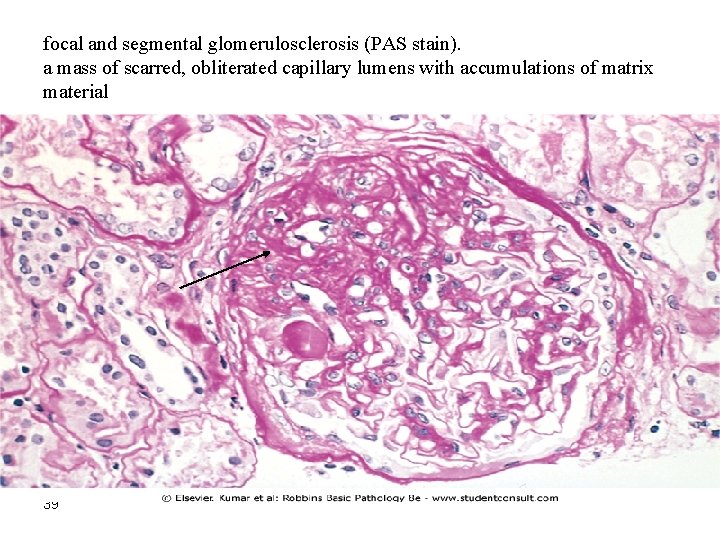 focal and segmental glomerulosclerosis (PAS stain). a mass of scarred, obliterated capillary lumens with