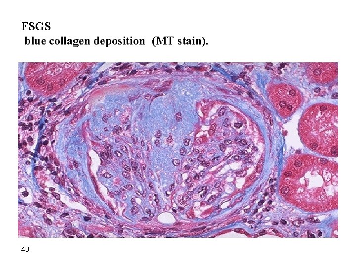 FSGS blue collagen deposition (MT stain). 40 