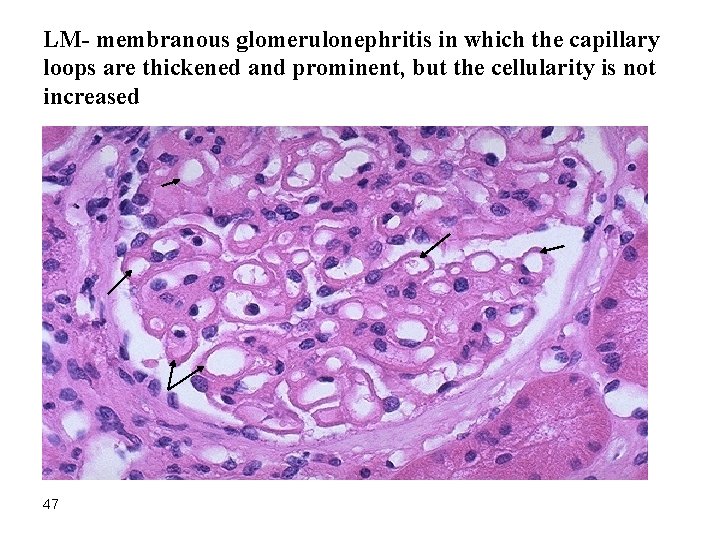 LM- membranous glomerulonephritis in which the capillary loops are thickened and prominent, but the