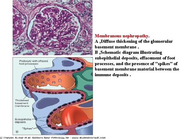 Membranous nephropathy. A , Diffuse thickening of the glomerular basement membrane. B , Schematic