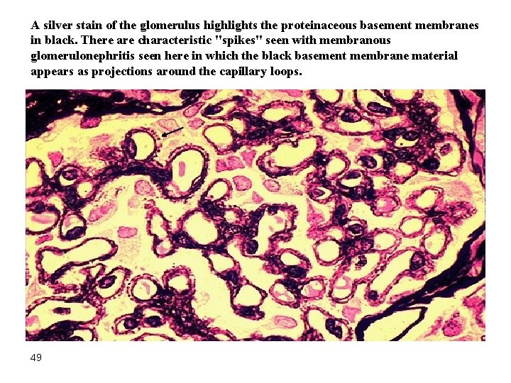 A silver stain of the glomerulus highlights the proteinaceous basement membranes in black. There