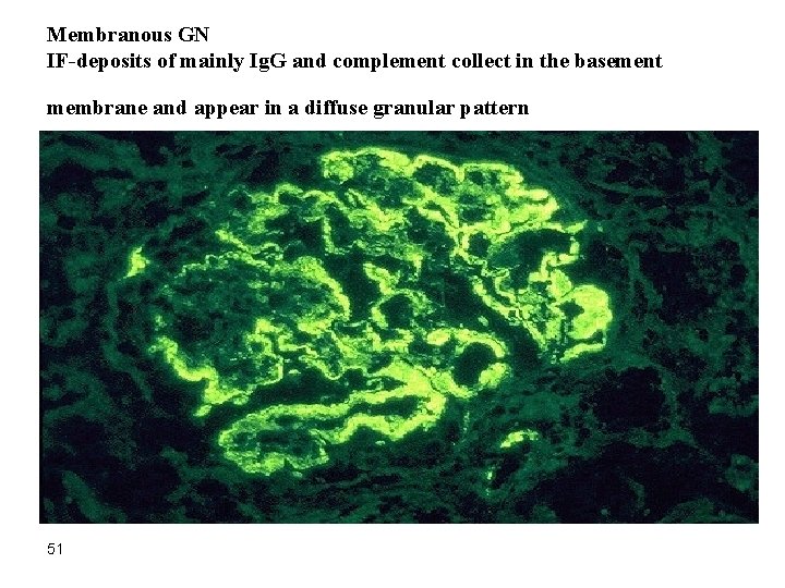 Membranous GN IF-deposits of mainly Ig. G and complement collect in the basement membrane