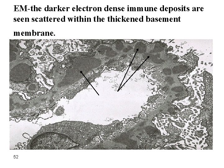 EM-the darker electron dense immune deposits are seen scattered within the thickened basement membrane.