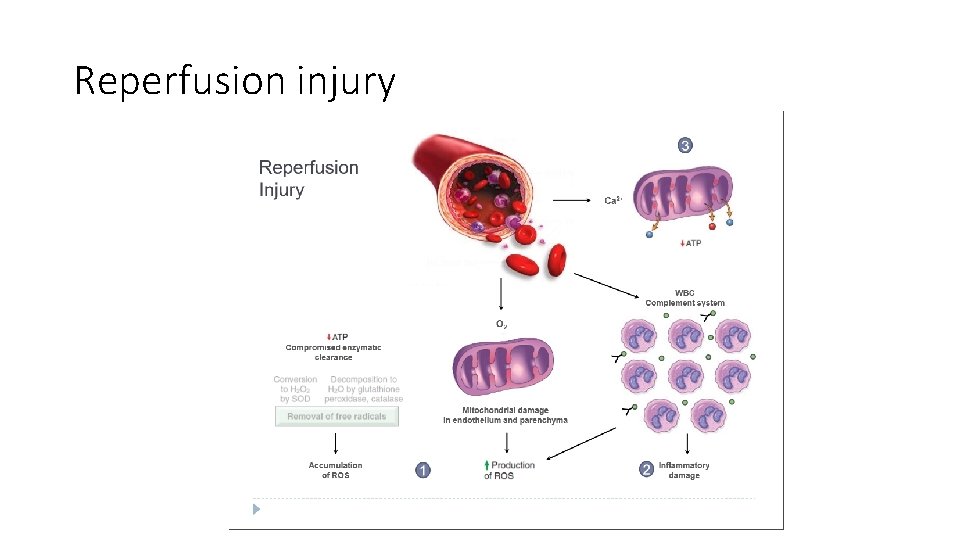 Reperfusion injury 