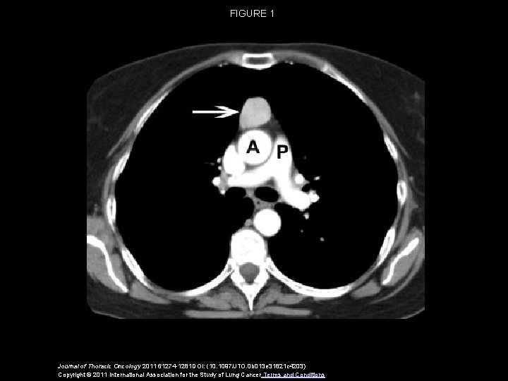 FIGURE 1 Journal of Thoracic Oncology 2011 61274 -1281 DOI: (10. 1097/JTO. 0 b
