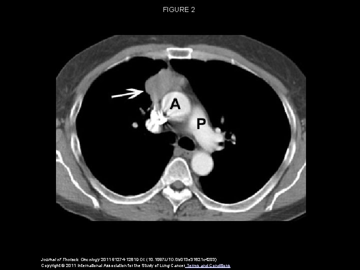 FIGURE 2 Journal of Thoracic Oncology 2011 61274 -1281 DOI: (10. 1097/JTO. 0 b