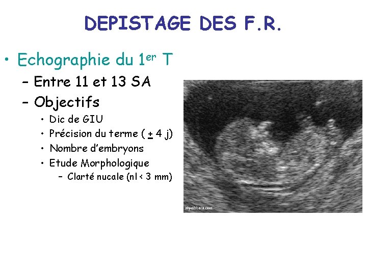 DEPISTAGE DES F. R. • Echographie du 1 er T – Entre 11 et